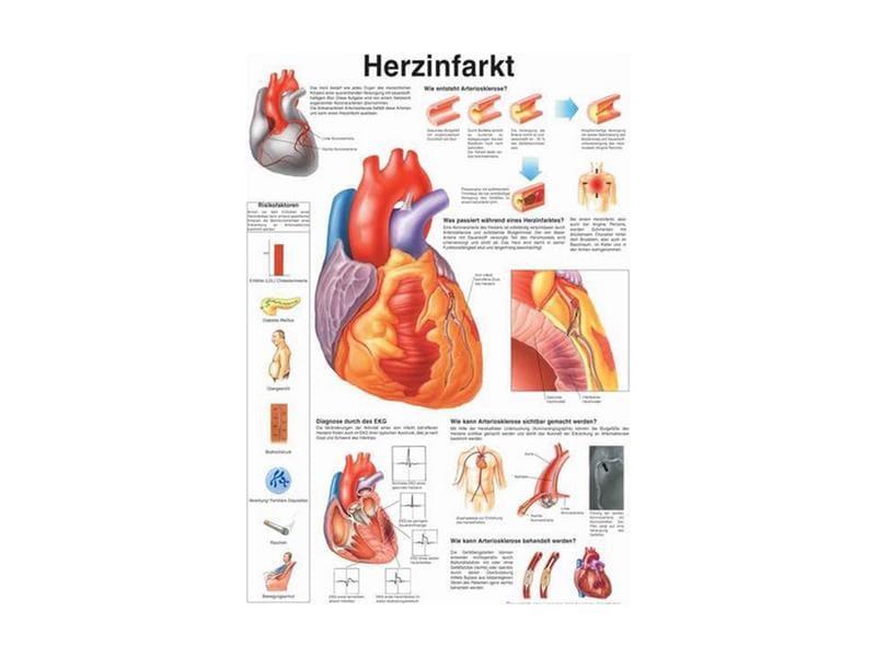 Rüdiger Planche anatomique Infarctus du myocarde laminé Allemand